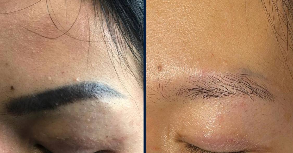 Resultat detatouage 1