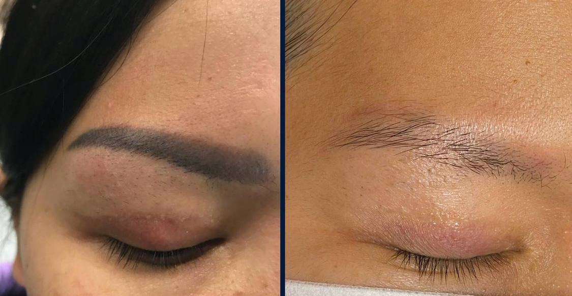 Resultat detatouage 2