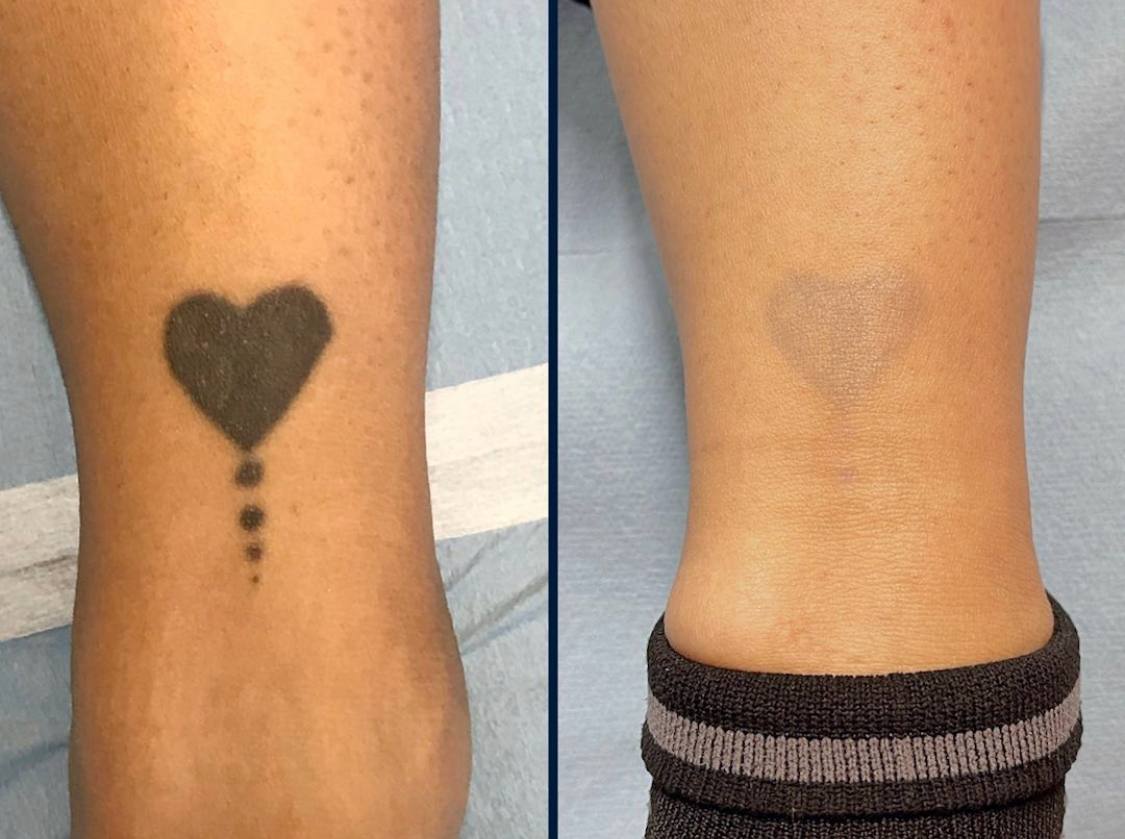 Resultat detatouage 4